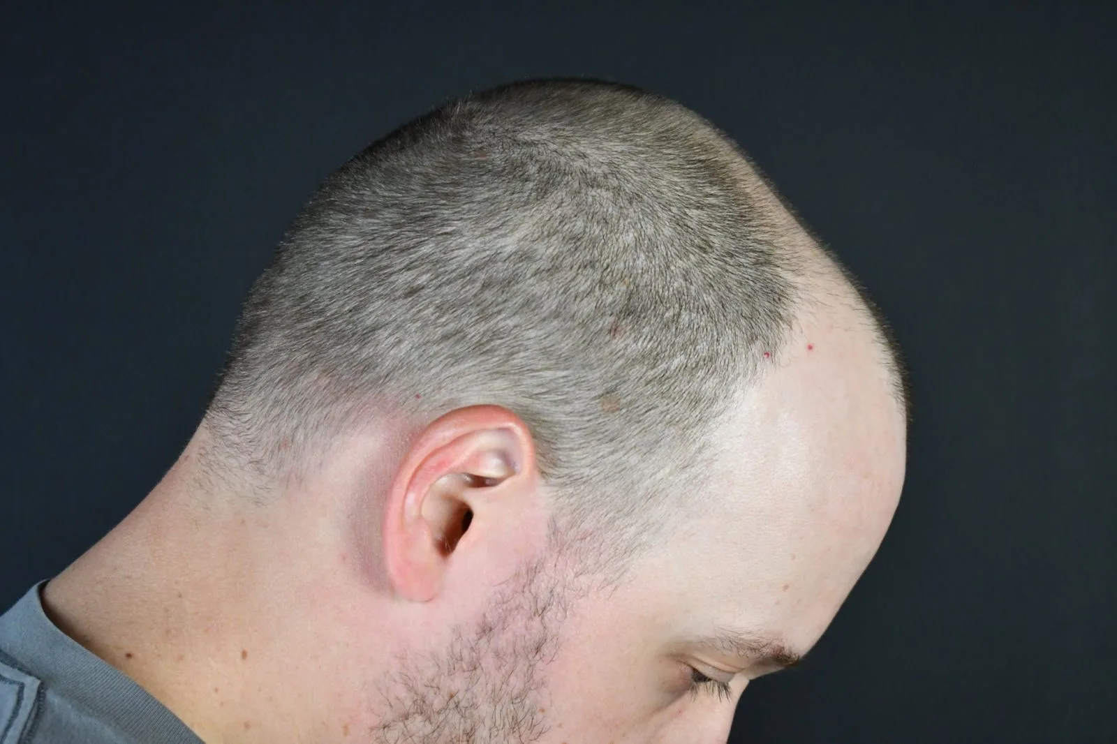Side profile of a person's head showing scalp and ear against a dark background